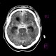 Comminuted fracture of skull base, frontal sinus, sphenoid sinus, hemosinus, pneumocephalus, contusion, subarachnoid hemorrhage: CT - Computed tomography
